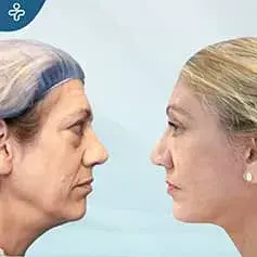 Lifting SMAS étendu avant et après