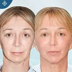 Prima e Dopo del Trasferimento di Grasso