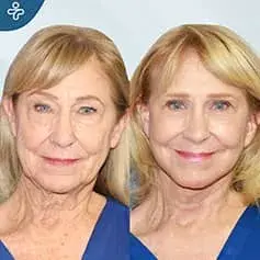 Lifting Facciale Completo, Lifting del Collo e Trasferimento di Grasso al Viso Prima e Dopo