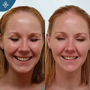 Avant et Après Chirurgie de Lifting du Front