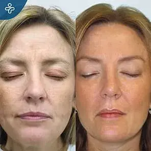 Transformation du Front et du Visage