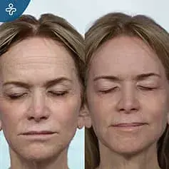 Avant et Après Chirurgie du Front