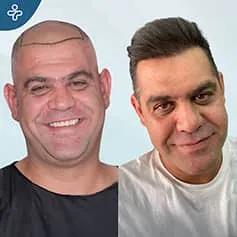 before-after-hair-transplant-3-1