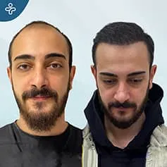 before-after-hair-transplant-5-1