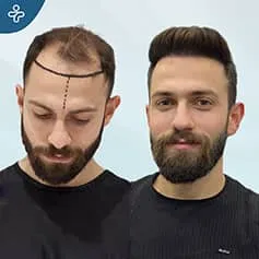 before-after-hair-transplant-6-1
