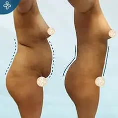 360-Liposuktion Vorher & Nachher