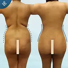 360-Liposuktion Vorher & Nachher