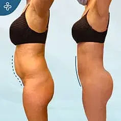 BBL und Liposuktion Vorher/Nachher