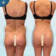 BBL und Liposuktion Vorher/Nachher