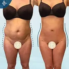 BBL und Liposuktion Vorher/Nachher