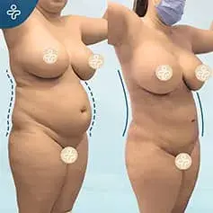 Mega-Liposuktion Vorher und Nachher