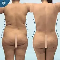 Mega-Liposuktion Vorher und Nachher