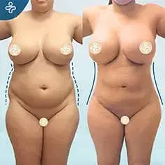 Mega-Liposuktion Vorher und Nachher