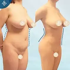 Sanduhr-Liposuktion Vorher und Nachher