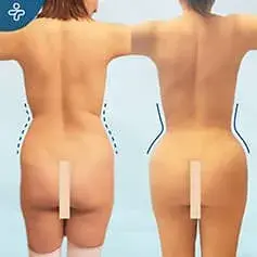 Sanduhr-Liposuktion Vorher und Nachher