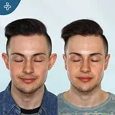Risultati Prima e Dopo del Rimodellamento delle Orecchie