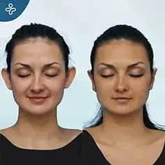 Otoplastica Prima e Dopo Senza Filtri