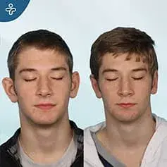 Otoplastica Maschile Prima e Dopo