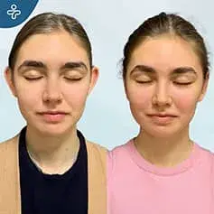 Otoplastica Femminile