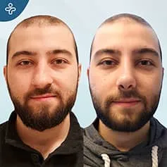 Before After