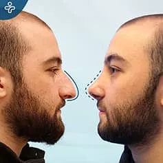 Before After