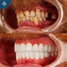 Full Hollywood sorriso prima e dopo Makeover