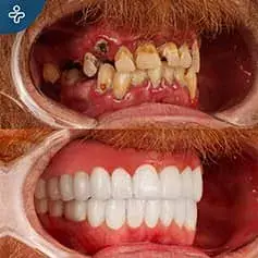 Full Hollywood sorriso prima e dopo Makeover