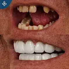 Impianto singolo dente e corone prima e dopo