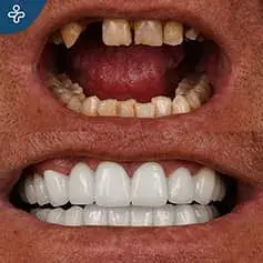 Single Tooth Implant and Crowns Before & After