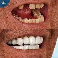 Impianto singolo dente e corone prima e dopo