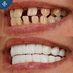 Full Hollywood sorriso prima e dopo Makeover