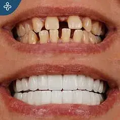 Faccette dentali a bocca piena in Turchia prima e dopo