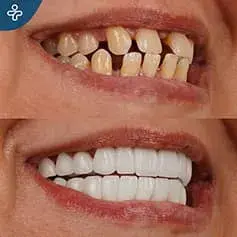 Faccette dentali a bocca piena in Turchia prima e dopo