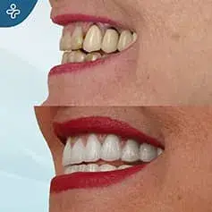 Rifacimento completo del sorriso prima e dopo