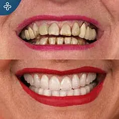 Rifacimento completo del sorriso prima e dopo