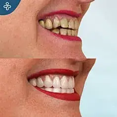 Rifacimento completo del sorriso prima e dopo