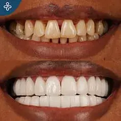Hollywood sorriso compiuto