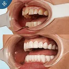 Impianti dentali a bocca piena