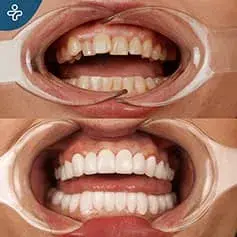 Impianti dentali a bocca piena