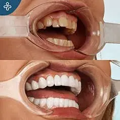 Impianti dentali a bocca piena