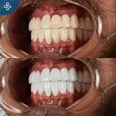 Blanqueamiento Dental con Láser Antes y Después