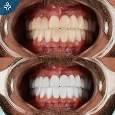 Blanqueamiento Dental con Láser Antes y Después