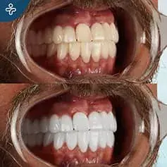 Blanqueamiento Dental con Láser Antes y Después