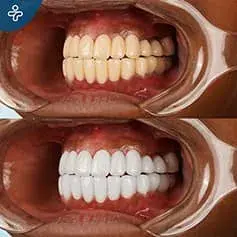 Transformación Dental Deslumbrante