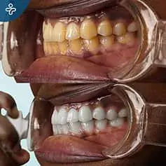Blanqueamiento Dental Intenso en Turquía Antes y Después