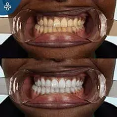 Blanqueamiento Dental Intenso en Turquía Antes y Después