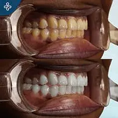 Blanqueamiento Dental Intenso en Turquía Antes y Después