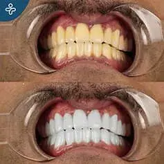 Tratamiento Láser para Dientes Blancos como la Nieve
