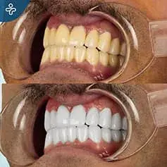 Tratamiento Láser para Dientes Blancos como la Nieve
