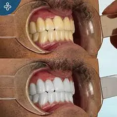 Tratamiento Láser para Dientes Blancos como la Nieve